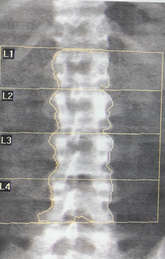 Osteoblastic cells growing in culture. Individual patient's cells have different morphology and growth rates.